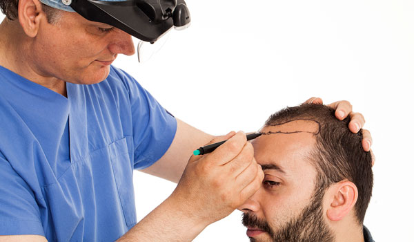haar-transplantation Haar-Transplantation