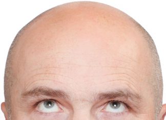 Eigenblut-Behandlung gegen Haarausfall