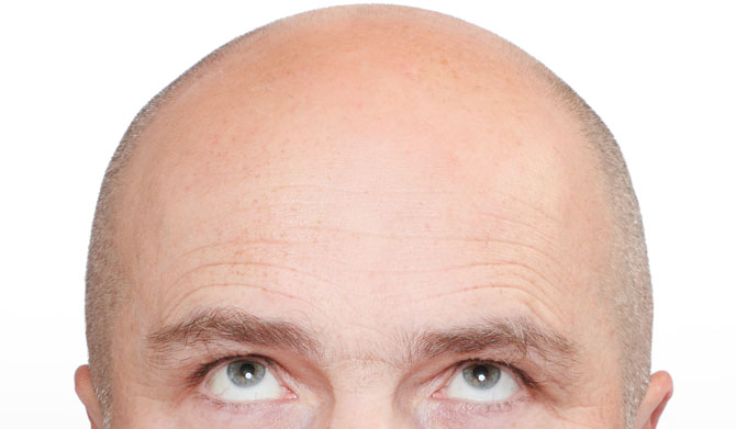 Eigenblut-Behandlung gegen Haarausfall