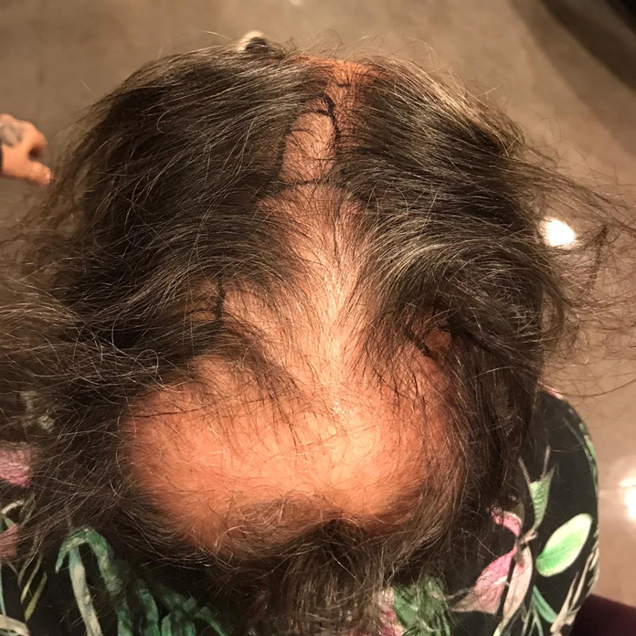 Haartransplantation Türkei vorher