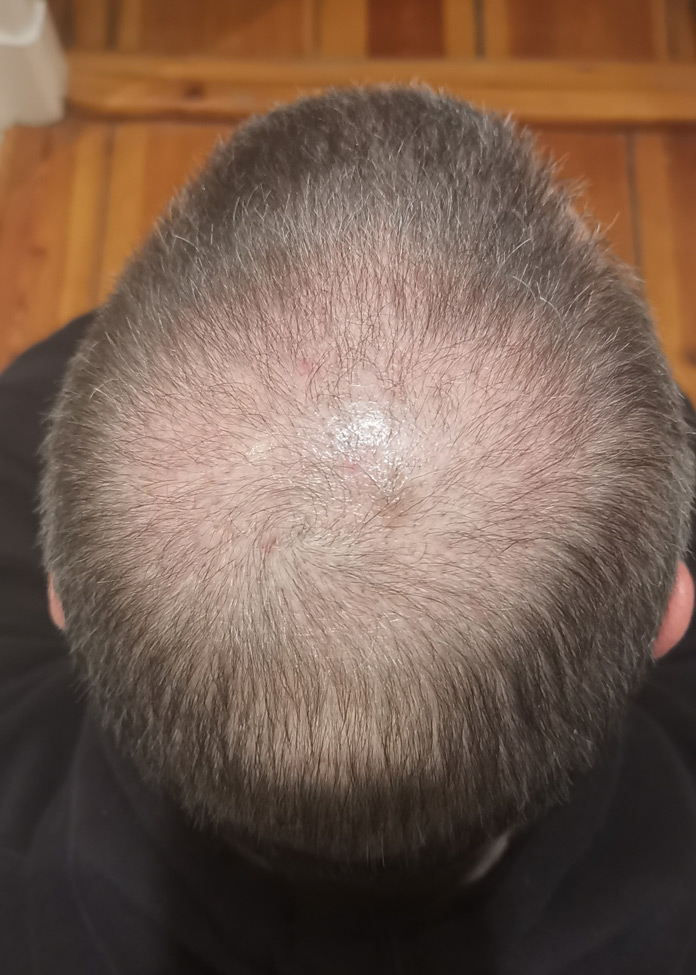 Haartransplantation Fortschritt Wachstum