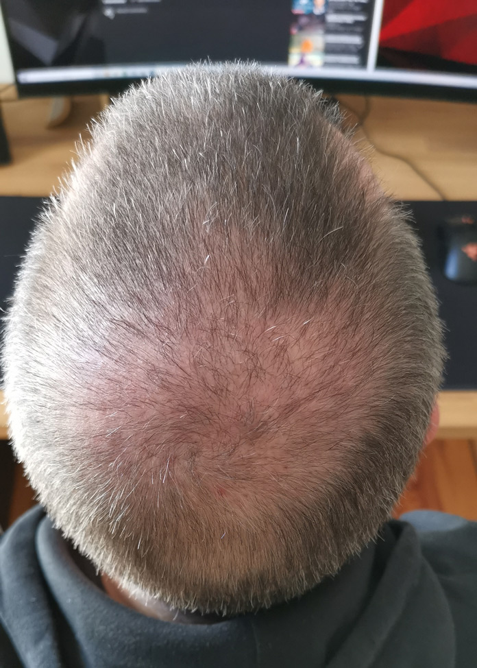 Haartransplantation Fortschritt Wachstum