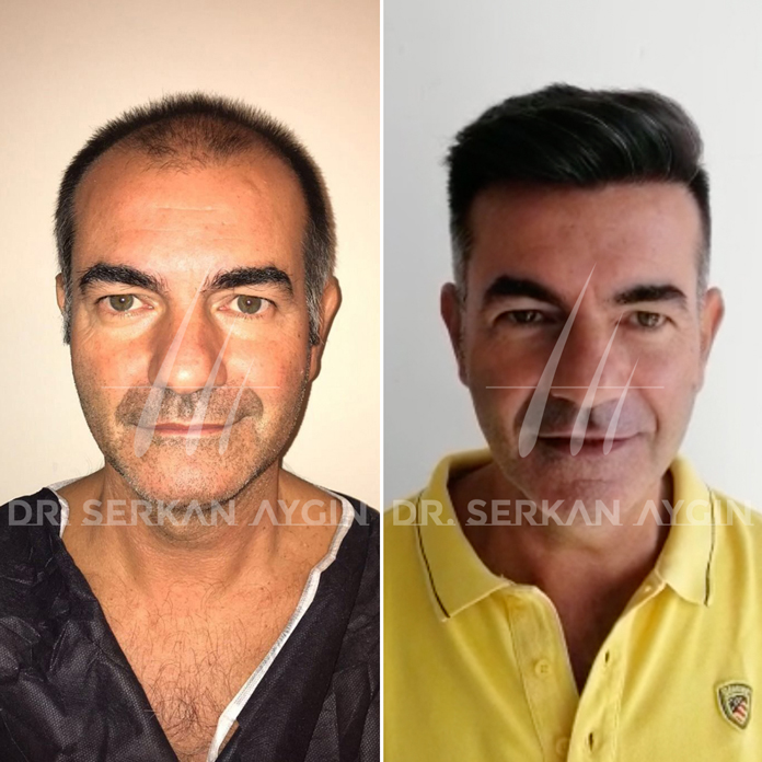 Haartransplantation Türkei vorher nachher